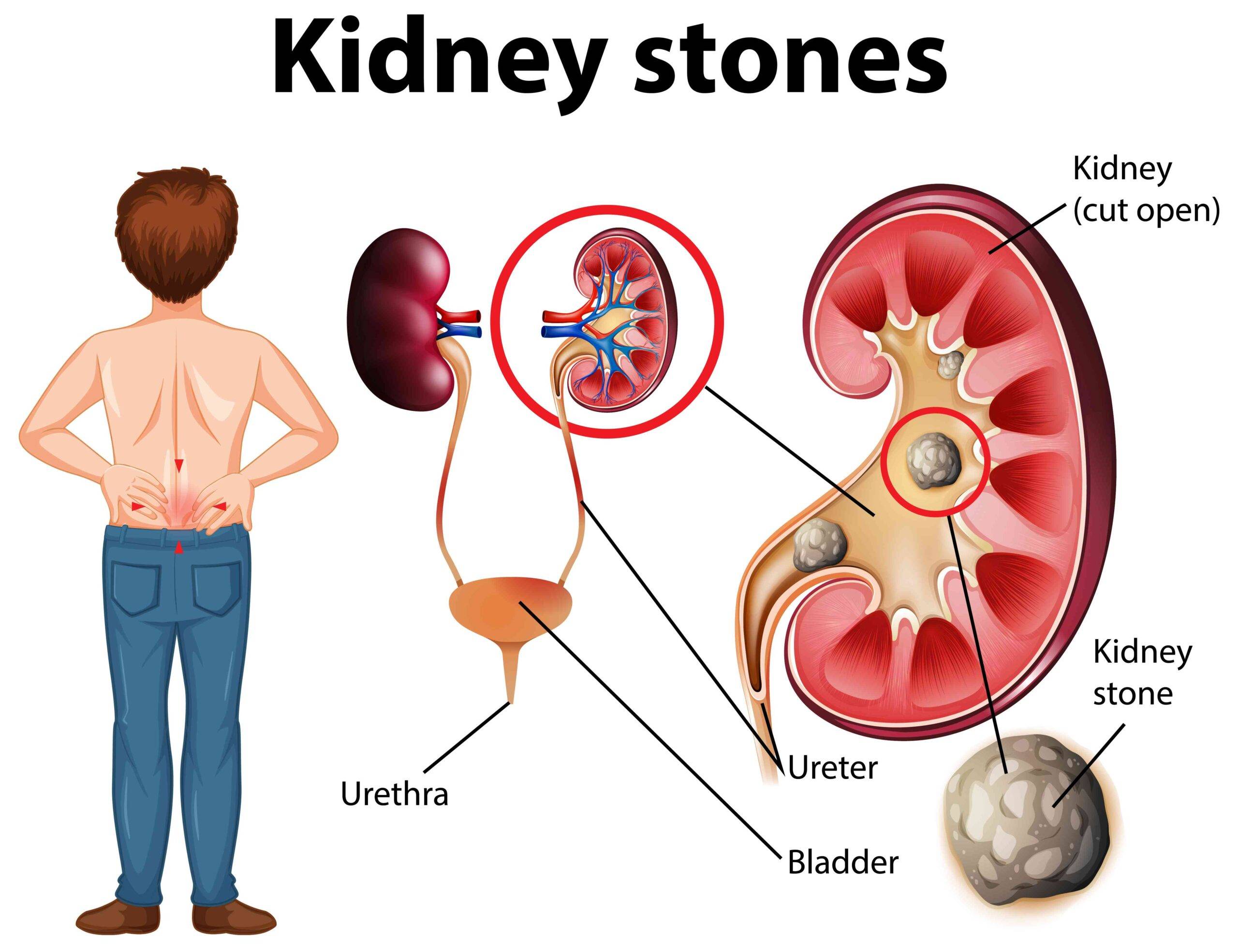 Kidney Stone Visualization via NIH Research